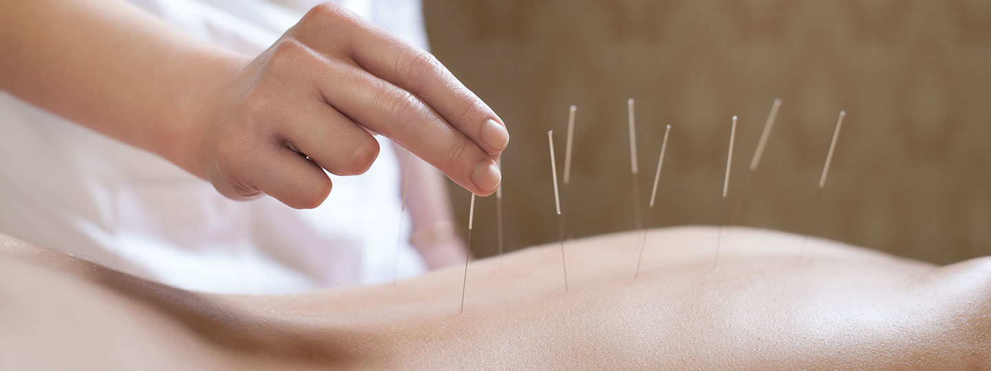 Eine Ärztin setzt Akupunkturnadeln im Rücken eines Patienten.